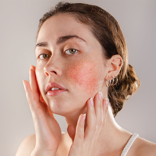 Skin Problems