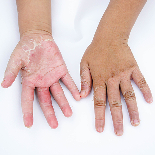Homeopathic Skin Treatment