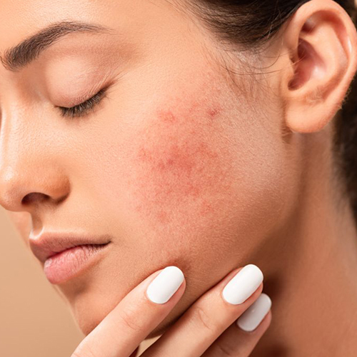 Acne & Scars