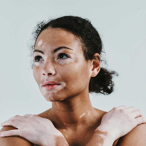 Vitiligo