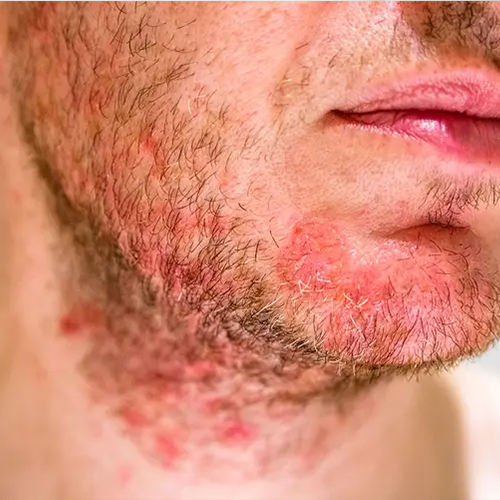 Seborrheic dermatitis