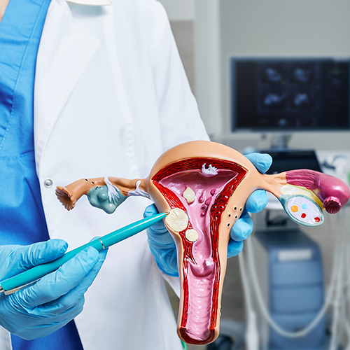 Fibroid