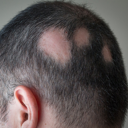 Alopecia