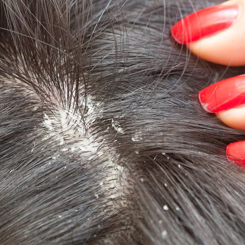 Dandruff
